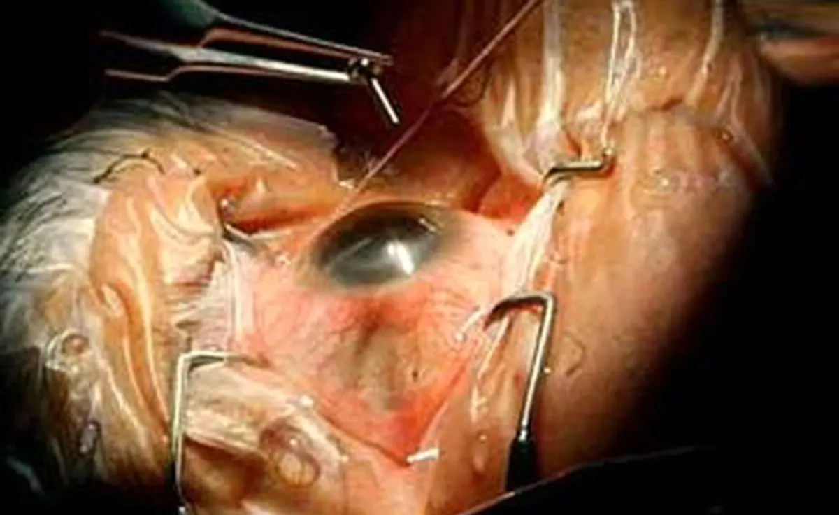 رئیس گروه گلوکوم کنگره چشم‌‌پزشکی از عرضه داروهای جدید گلوکم در آینده‌‌ نزدیک خبر داد