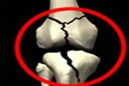 امگا ۳ تاثیری در پیشگیری از پوکی استخوان در بیماران ضایعات نخاعی ندارد