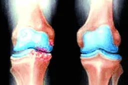 هشتمین کنگره آرتروپلاستی ایران برگزار شد