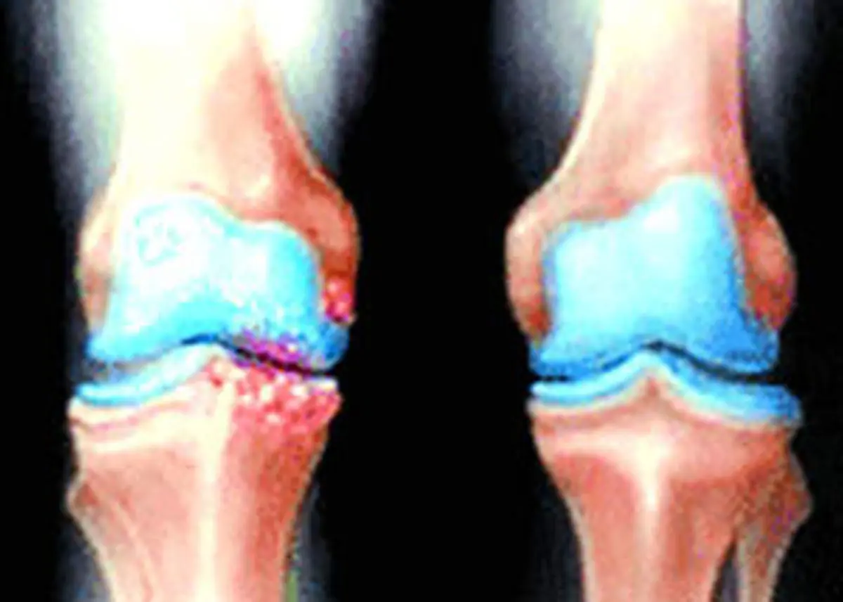 هشتمین کنگره آرتروپلاستی ایران برگزار شد