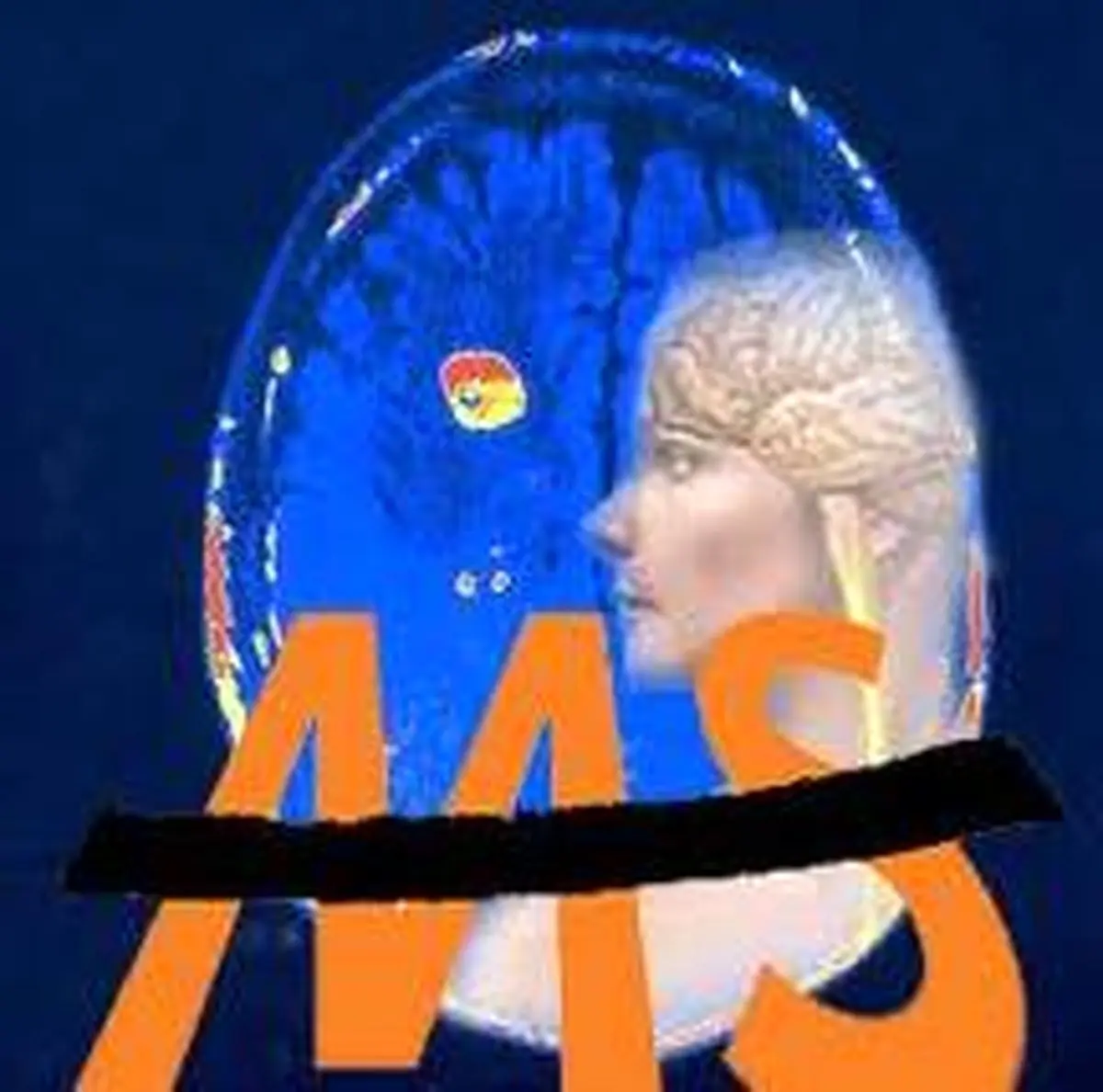 ۸۰ هزار ایرانی مبتلا به "ام اس" هستند