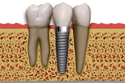 ایمپلنت‌های دندانی قیمت‌گذاری شد