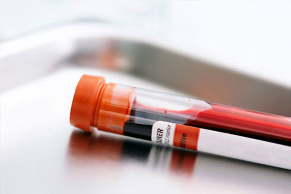 جمع‌آوری ۶۵ هزار نمونه خون بند ناف در کشور