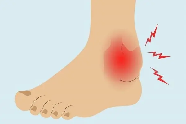 عوارض چاقی بر روی پاها چیست؟