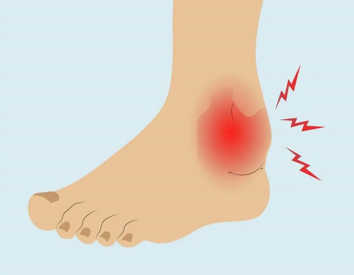 عوارض چاقی بر روی پاها چیست؟