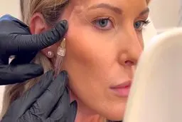 تزریق فیلر شقیقه برای لیفت صورت: راهکاری مؤثر برای جوان‌سازی چهره