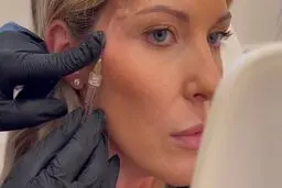 تزریق فیلر شقیقه برای لیفت صورت: راهکاری مؤثر برای جوان‌سازی چهره