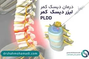 درمان دیسک کمر با PLDD (جدیدترین متد درمان فتق دیسک کمر خفیف)