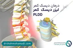 درمان دیسک کمر با PLDD (جدیدترین متد درمان فتق دیسک کمر خفیف)