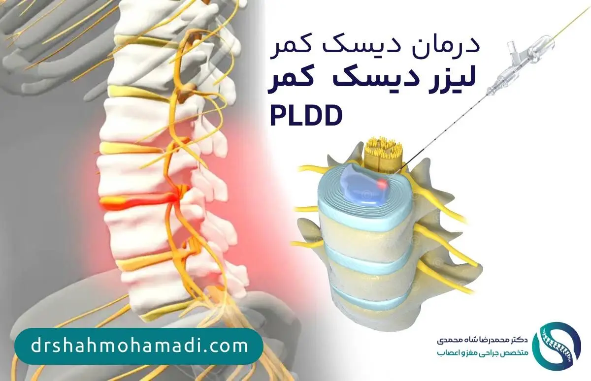 درمان دیسک کمر با PLDD (جدیدترین متد درمان فتق دیسک کمر خفیف)