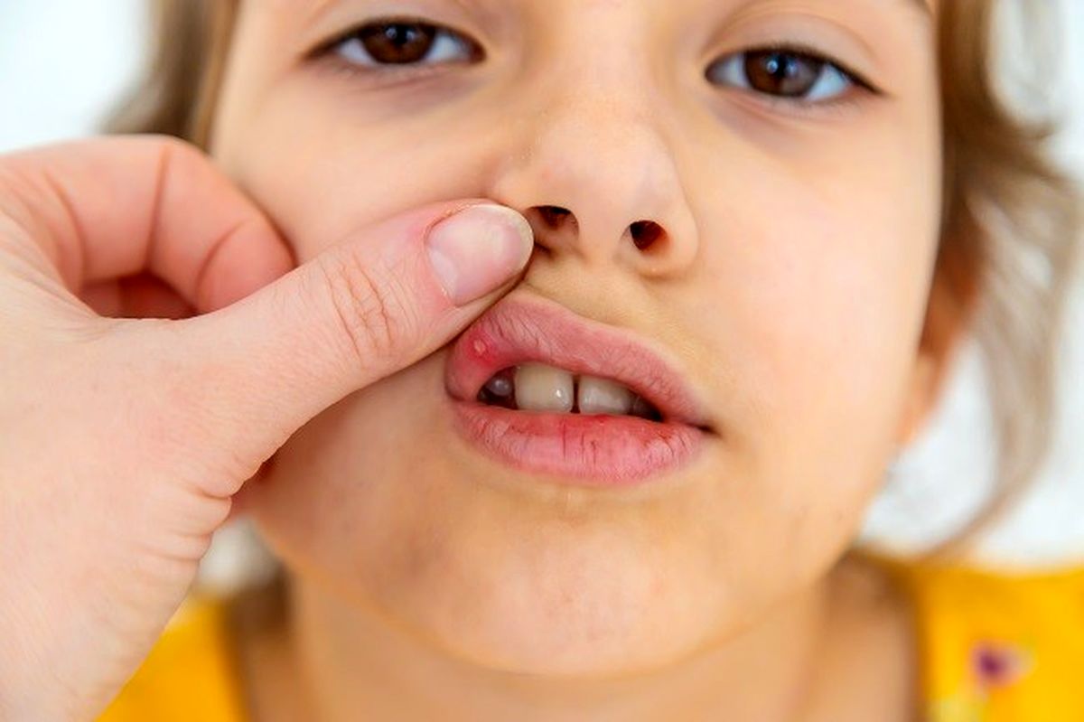 برفک دهان در نوزادان و کودکان؛ علائم و درمان ها