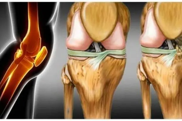 ساییدگی زانو در اثر چیست؟ 3 روش درمان سریع ساییدگی کشکک زانو