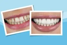 چطور کامپوزیت دندان، زندگی شما را تغییر می‌دهد؟ بررسی از زبان بیماران واقعی