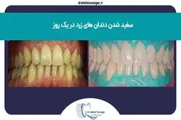 سفید شدن دندان‌های زرد در یک روز؛ واقعیت یا تبلیغ؟