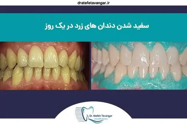 سفید شدن دندان‌های زرد در یک روز؛ واقعیت یا تبلیغ؟