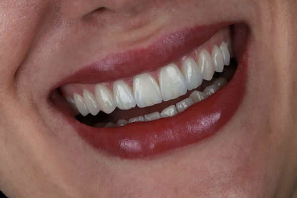 برای سفید کردن دندان ها از چه روش هایی می توانیم استفاده کنیم؟